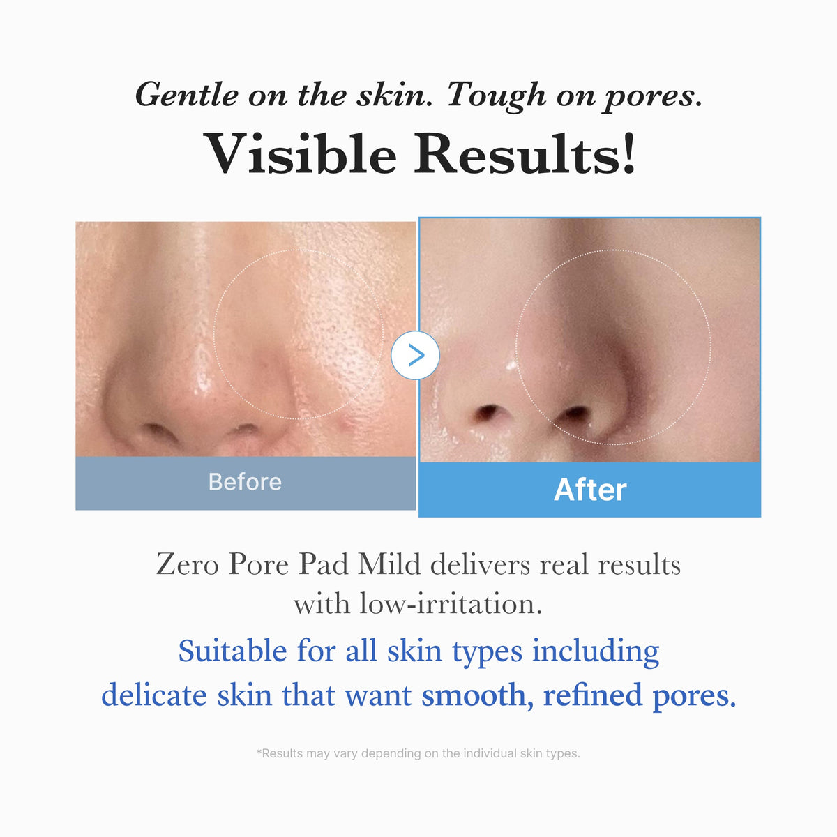 zero-pore-madecassoside-pads-mild-y0 04_6357f9f9-483b-4891-82c6-a58d336e62c8.jpg